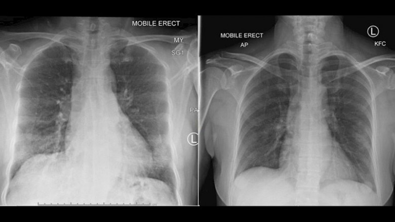 Investigadores fueron capaces de diseccionar la respuesta inmune que condujo a la recuperación exitosa de COVID-19, que podría ser el secreto para encontrar una vacuna eficaz | DOHERTY INSTITUTE ep investigadores fueron capaces de diseccionar la respuesta inmune que condujo a la recuperacion