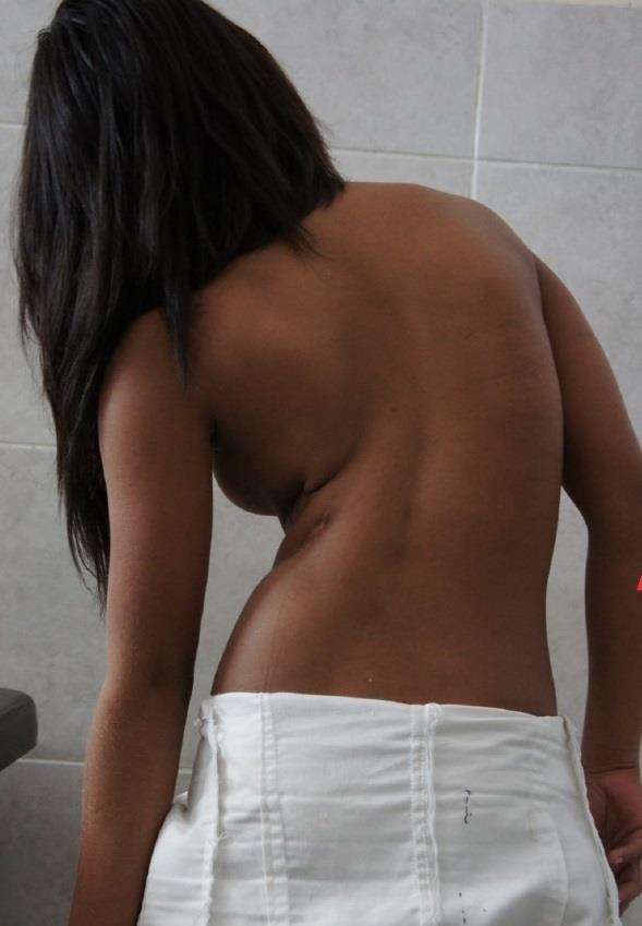 Joven con escoliosis | HOSPITAL VITHAS SAN JOSÉ ep jovenescoliosis