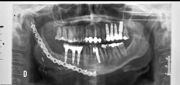 ep reconstrucciones mandibularesprecisastecnologias 3d