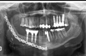 ep reconstrucciones mandibularesprecisastecnologias 3d