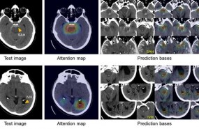 ep hemorragia cerebral