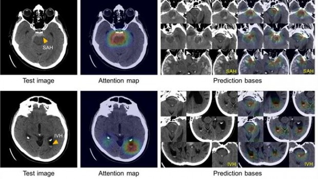 ep hemorragia cerebral