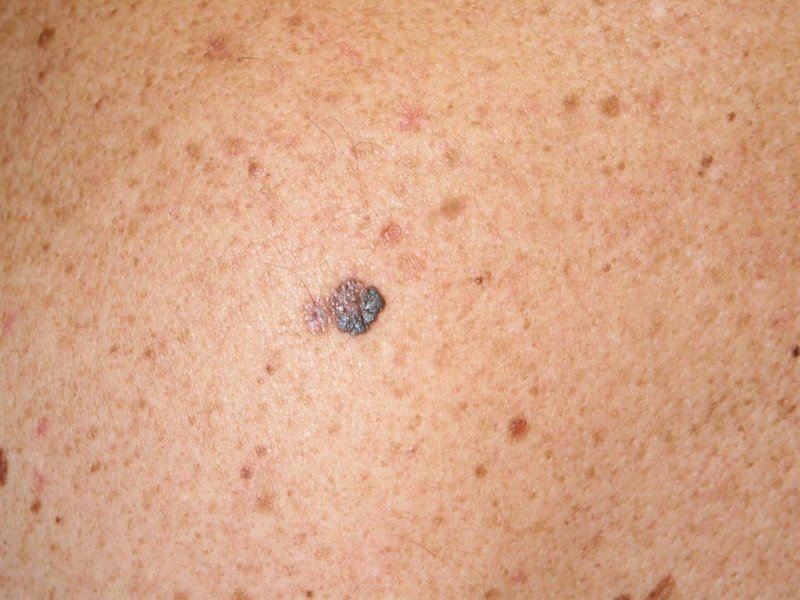 ep melanoma