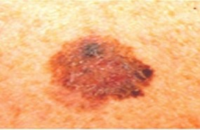 ep melanoma