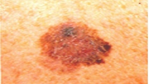 ep melanoma
