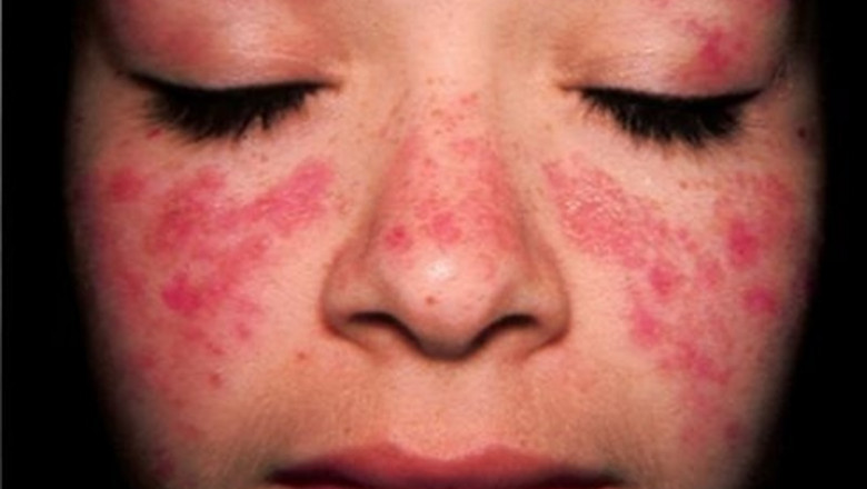 Mujer con lupus | FLICKR/LÊ VĂN THẢO - Archivo ep mujerlupus