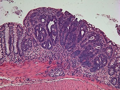 ep tumor de colon cancer