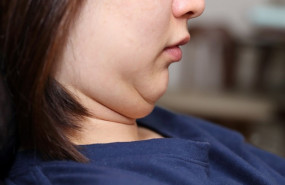 ep papada obesidad sobrepeso