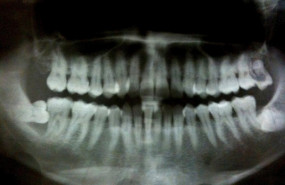 ep periodontitis 20200212190303
