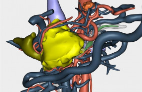 ep reconstruccion 3d de un tumor para abordar su reseccion en una cirugia a paciente oncologico