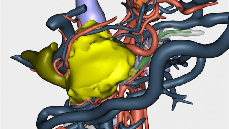 Reconstrucción 3D de un tumor para abordar su resección en una cirugía a paciente oncológico | HM HOSPITALES ep reconstruccion 3d de un tumor para abordar su reseccion en una cirugia a paciente oncologico