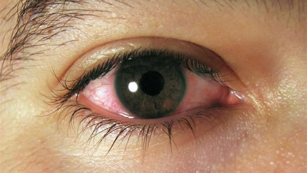 ep ojoconjuntivitis