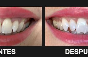 antes despues 20221128105605 antes despues 20221128105605