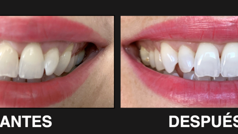 antes despues 20221128105605 