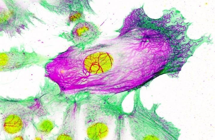 ep celulas de cancer de mama resistentes a los medicamentos rodeadas de celulas no resistentes el