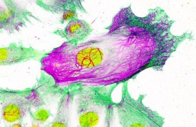 ep celulas de cancer de mama resistentes a los medicamentos rodeadas de celulas no resistentes el