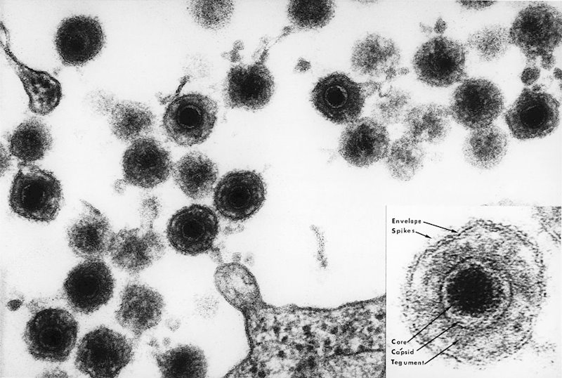 ep herpesvirus humano 6