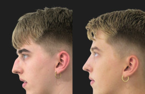 rinoplastia silvia roson5 rinoplastia silvia roson5