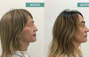 1581939988 icifacial feminizaci n