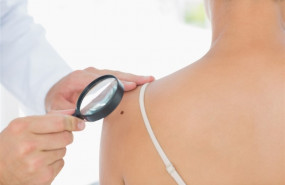 ep lunares cancerpiel melanoma 20190808123503