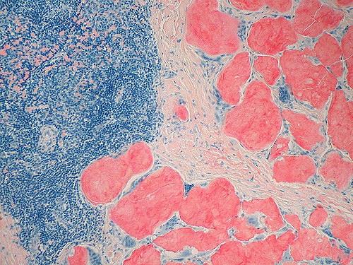 ep amiloidosis 20180725145002