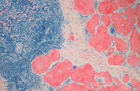 ep amiloidosis 20180725145002