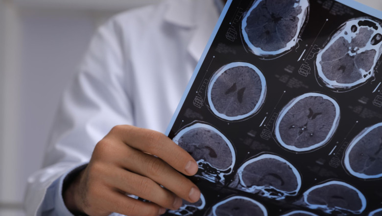 alzheimer aei alzheimer aei