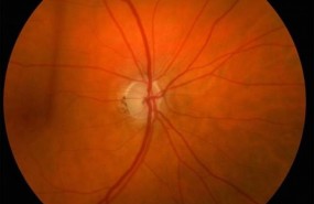 ep glaucoma 20180312104902