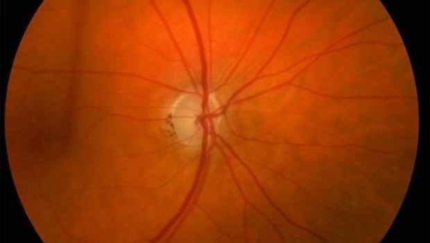 ep glaucoma 20180312104902
