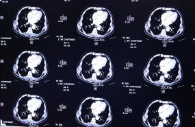 ep radiografias electroencefalogramas actividadcerebro tumor tumores cerebrales resonancia magnetica escaner escaneres cerebrales