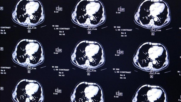 ep radiografias electroencefalogramas actividadcerebro tumor tumores cerebrales resonancia magnetica escaner escaneres cerebrales