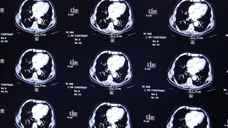 ep radiografias electroencefalogramas actividadcerebro tumor tumores cerebrales resonancia magnetica escaner escaneres cerebrales