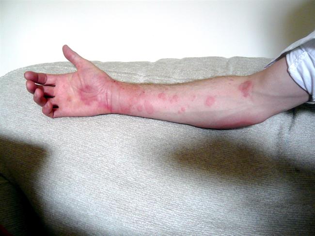 ep urticaria brazo piel enfermedad