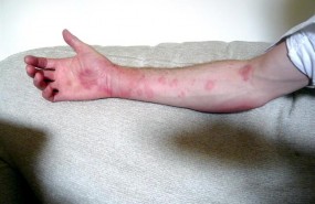 ep urticaria brazo piel enfermedad