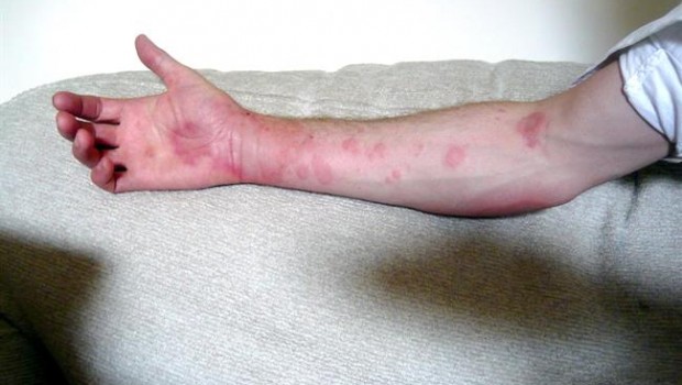 ep urticaria brazo piel enfermedad