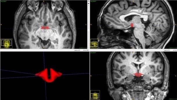 ep resonancia magnetica cerebral que muestra el hipotalamo en rojo