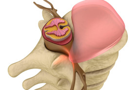 hernia discal dr carlos morales malaga 2023 20231130120723 