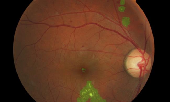 Desarrollan un nuevo sistema para detectar de forma temprana daños en la retina | UPV ep desarrollannuevo sistemadetectarforma temprana danosla retina