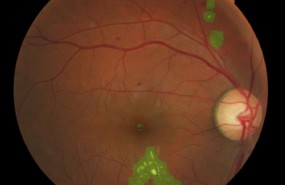 ep desarrollannuevo sistemadetectarforma temprana danosla retina