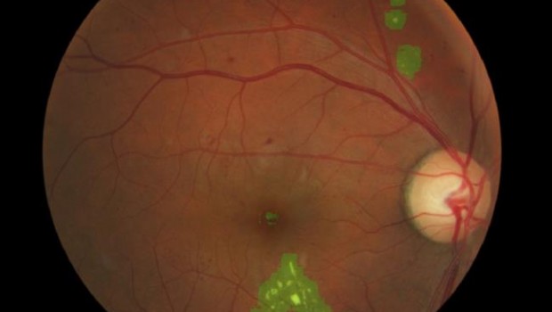 ep desarrollannuevo sistemadetectarforma temprana danosla retina