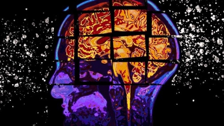 Este modelo desarrollado en el MIT predice el declive cognitivo de los pacientes en riesgo de padecer la enfermedad de Alzheimer al pronosticar sus puntuaciones en las pruebas de cognición hasta dos años antes | CHRISTINE DANILOFF, MIT ep este modelo desarrolladomit predicedeclive cognitivolos pacientesriesgopadecerenfermedadalzheimerpronosticarpuntuacioneslas pruebascogniciondos anos antes