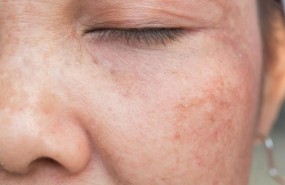 ep melasma pigmentacionla piel laserdermatologia