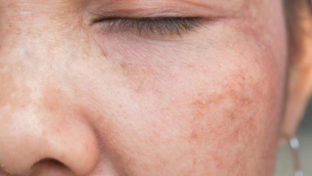 ep melasma pigmentacionla piel laserdermatologia