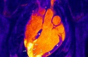 ep corazonun infarto agudomiocardio