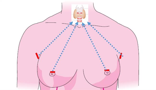 Nueva técnica que permite extirpar el tiroides sin dejar cicatriz en el cuello | VITHAS INTERNACIONAL ep nueva tecnicapermite extirpartiroidesdejar cicatrizcuello