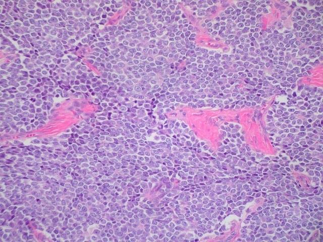 Sarcoma de Ewing | FLICKR/ED UTHMAN ep sarcomaewing