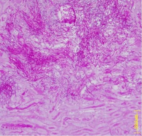 ep tincion histologicaun corterinon infectadocandida