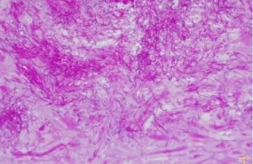 ep tincion histologicaun corterinon infectadocandida