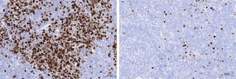 A la izquierda, linfoma folicular en ratón con abundantes células B en multiplicación teñidas en marrón. A la derecha, inhibición de esta multiplicación por el tratamiento con rapamicina. | CNIO ep aizquierda linfoma folicularratonabundantes celulas bmultiplicacion tenidasmarron aderecha inhibicionesta multiplicaciontratamientorapamicina