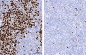 ep aizquierda linfoma folicularratonabundantes celulas bmultiplicacion tenidasmarron aderecha inhibicionesta multiplicaciontratamientorapamicina